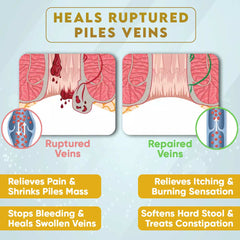 PILES MATRIX KIT - Piles Ayurvedic Supplements & Gel | Get Vein Restore + Rectum Restore + Healing Gel + Diet Booklet | Treats Hemorrhoids | 100% Natural